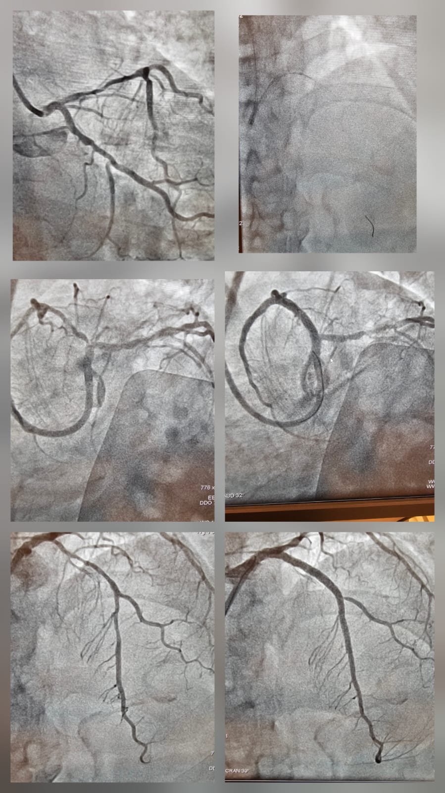 Complex coronary case