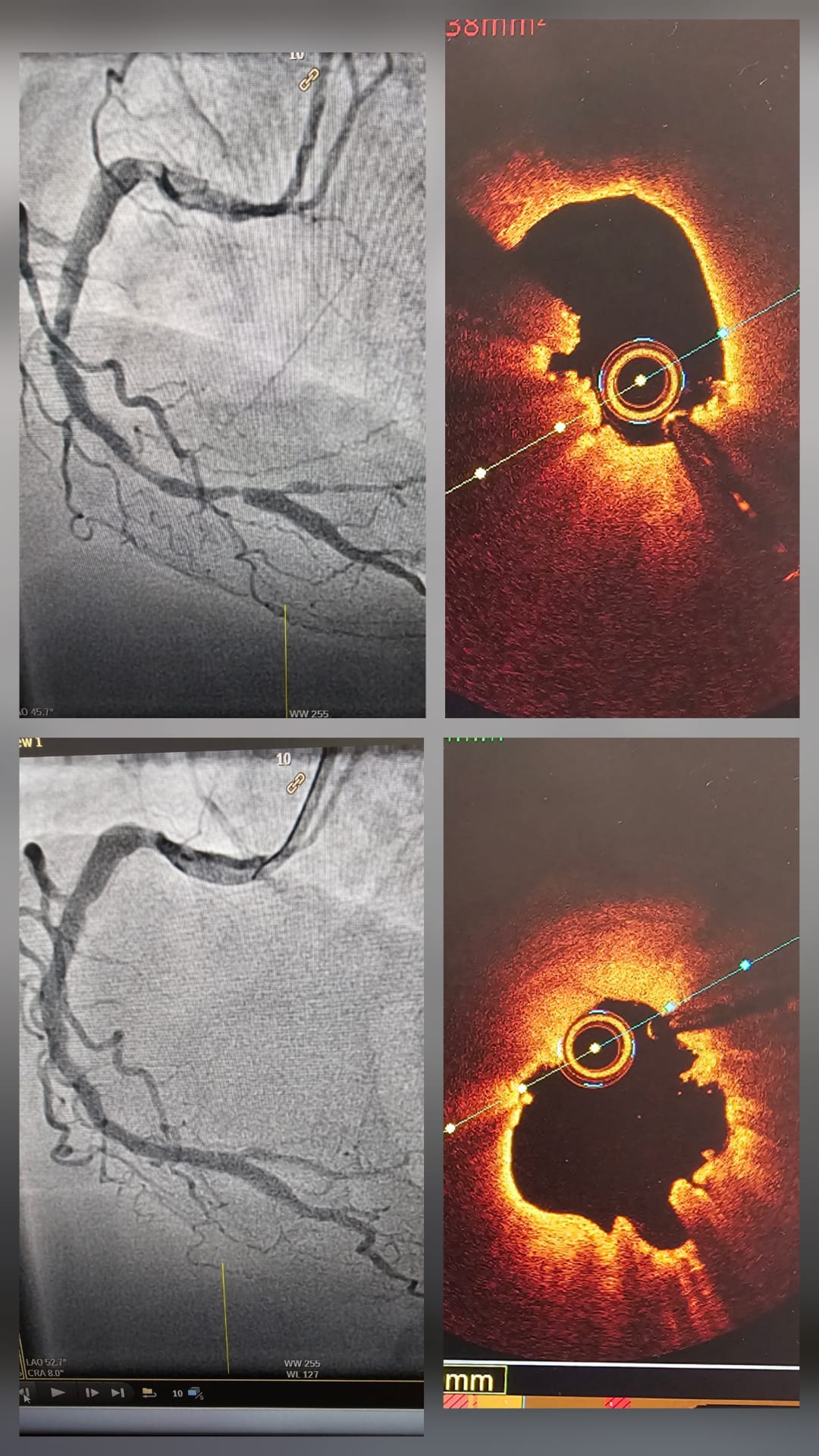 Imaging guided PCI with OCT