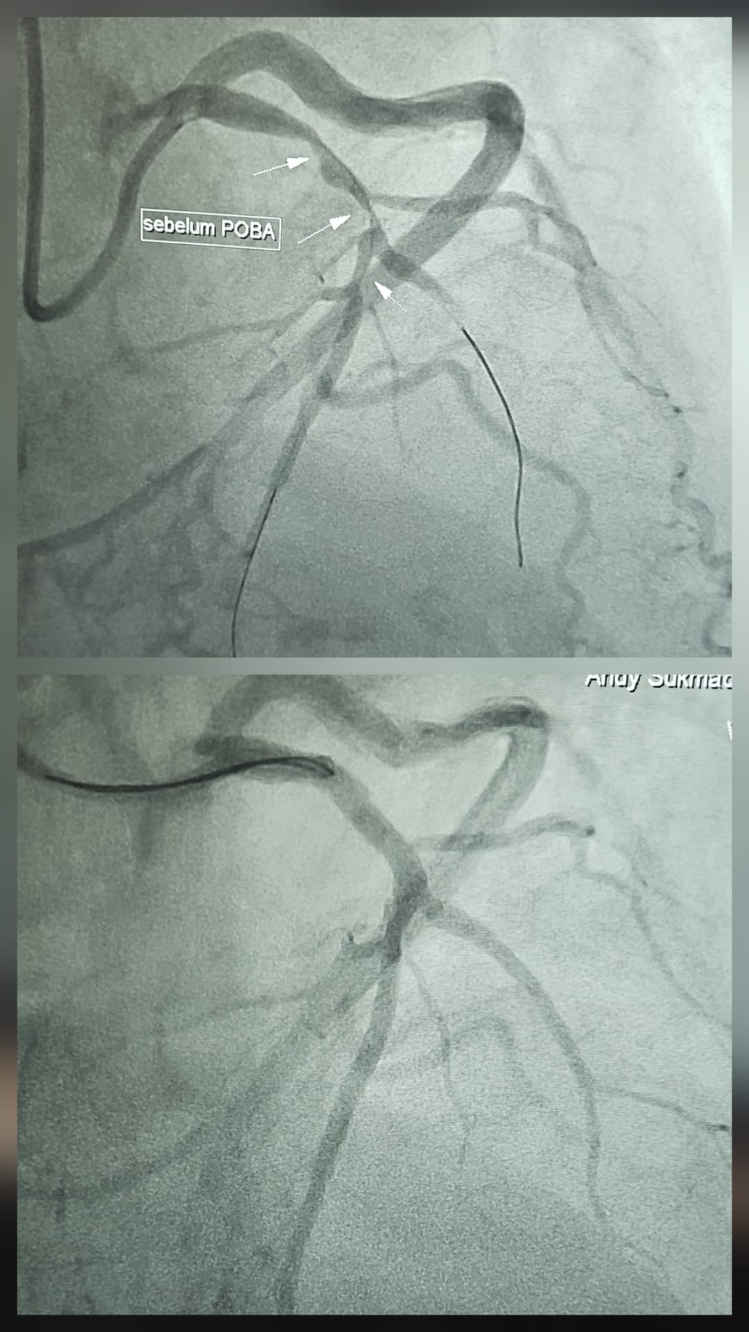 Full DCB Drug Coated Balloon in STEMI before and after