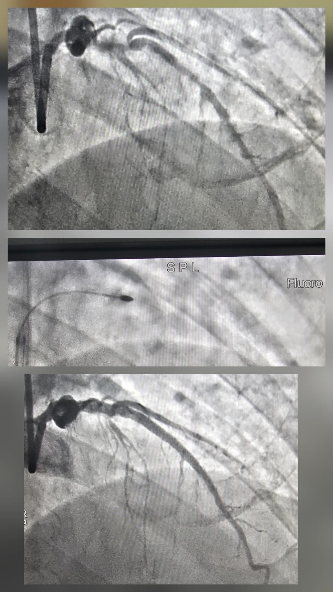 Highly calcified vessel with acute angle of diagonal branch