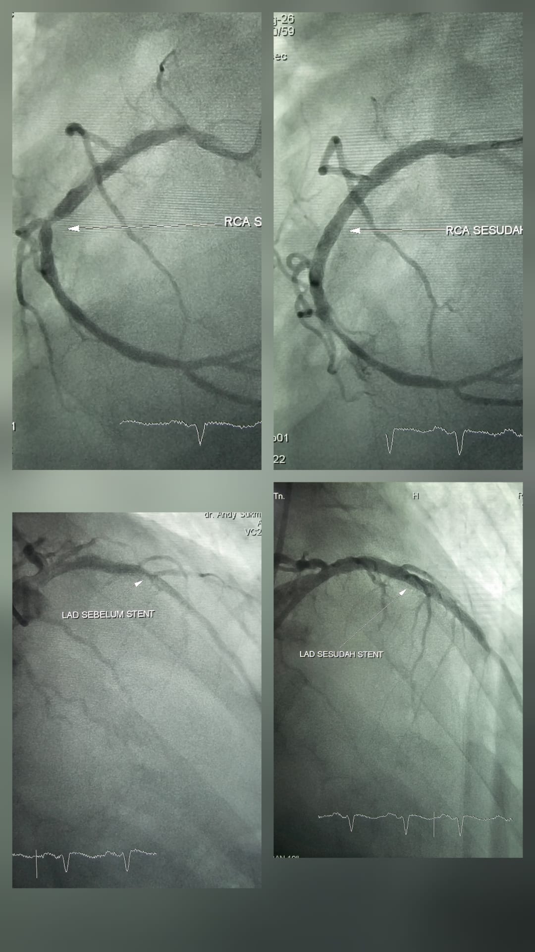 Complete revascularization after STEMI RCA and LAD stenting
