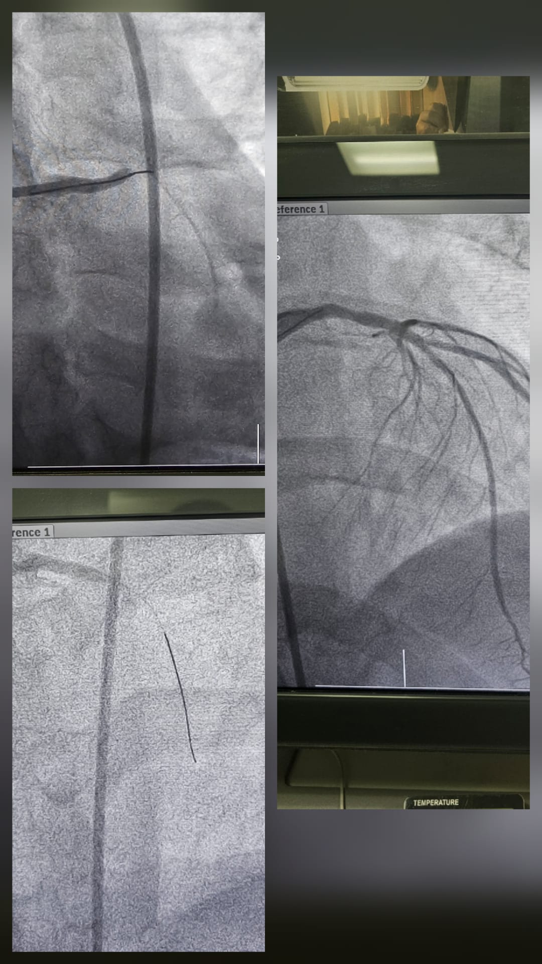 STEMI with Left Main Total Occlusion complex PCI case