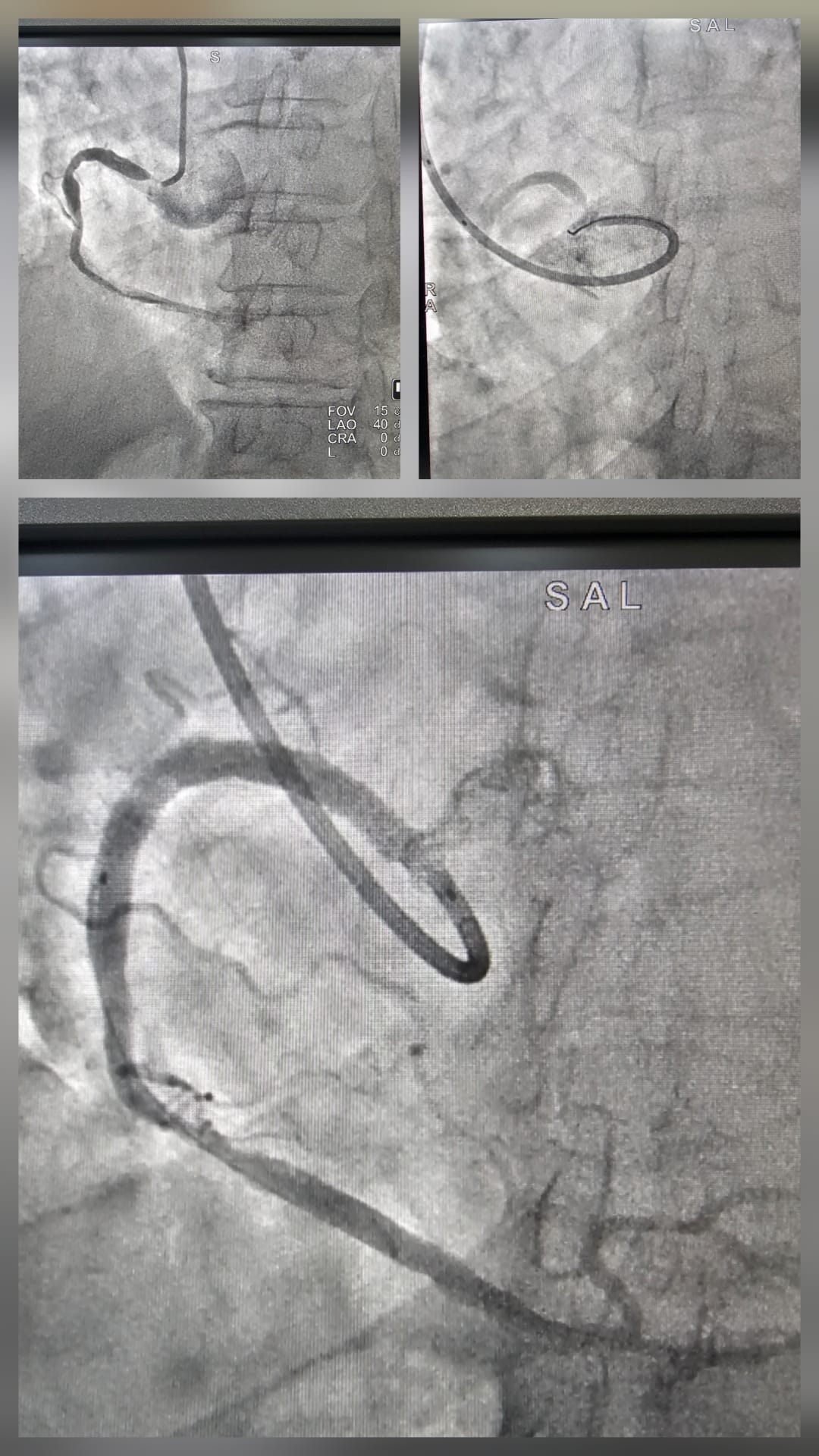 Subtotal occlusion of Right Coronary Artery RCA PCI