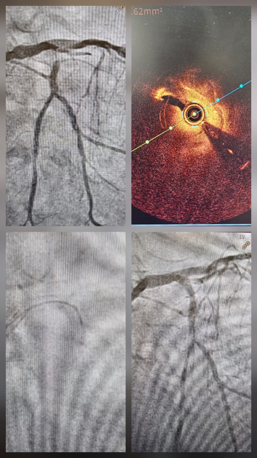 Orbital atherectomy calcium nodule guided by OCT imaging