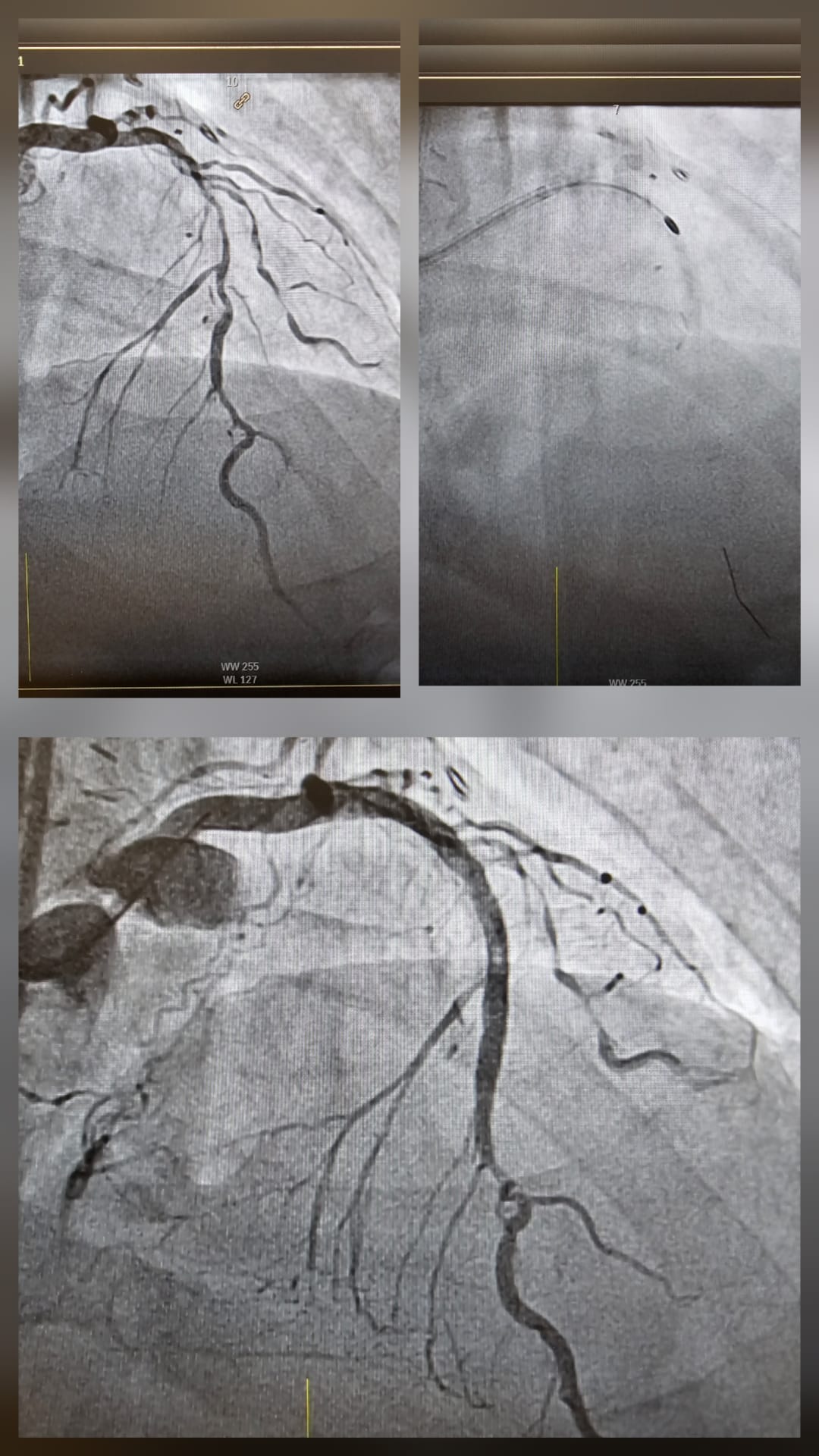 Severely calcified LAD vessel after LIMA graft occlusion complex PCI