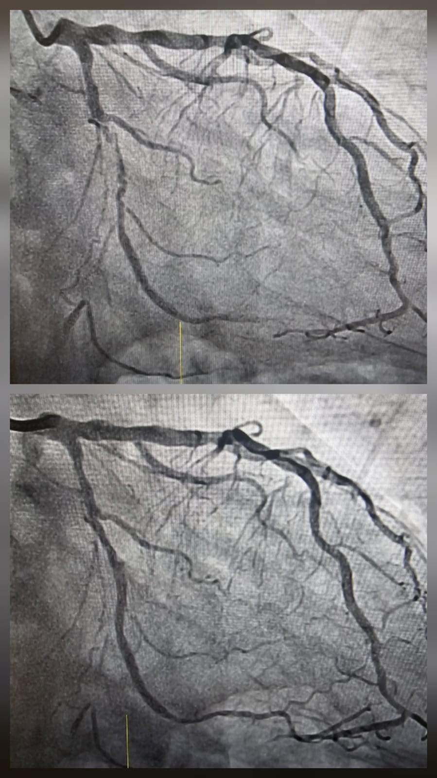 Coronary angiography and OCT imaging-guided PCI