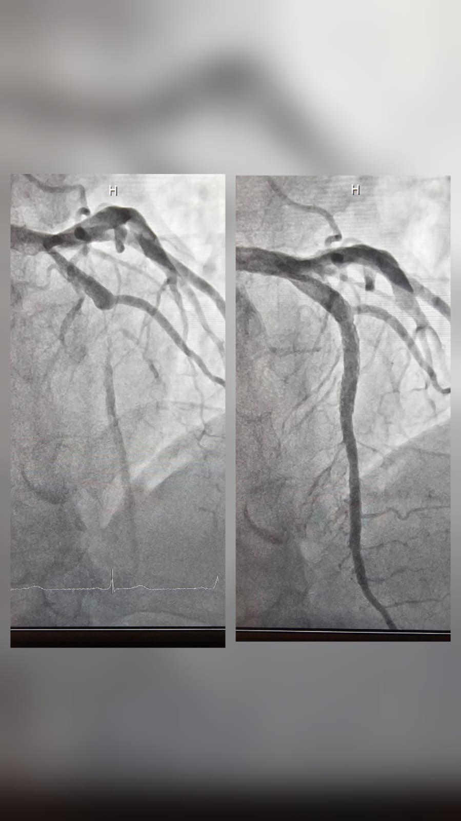 Left main bifurcation coronary angiogram