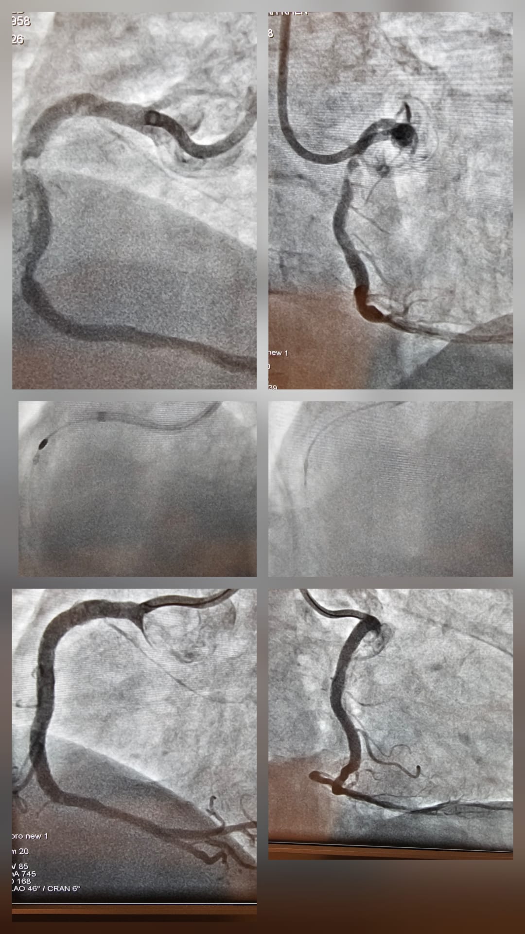 Before and after coronary angiogram