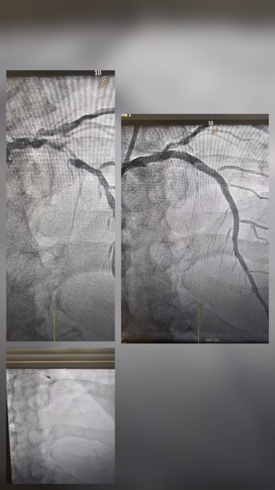 Complex PCI procedure case