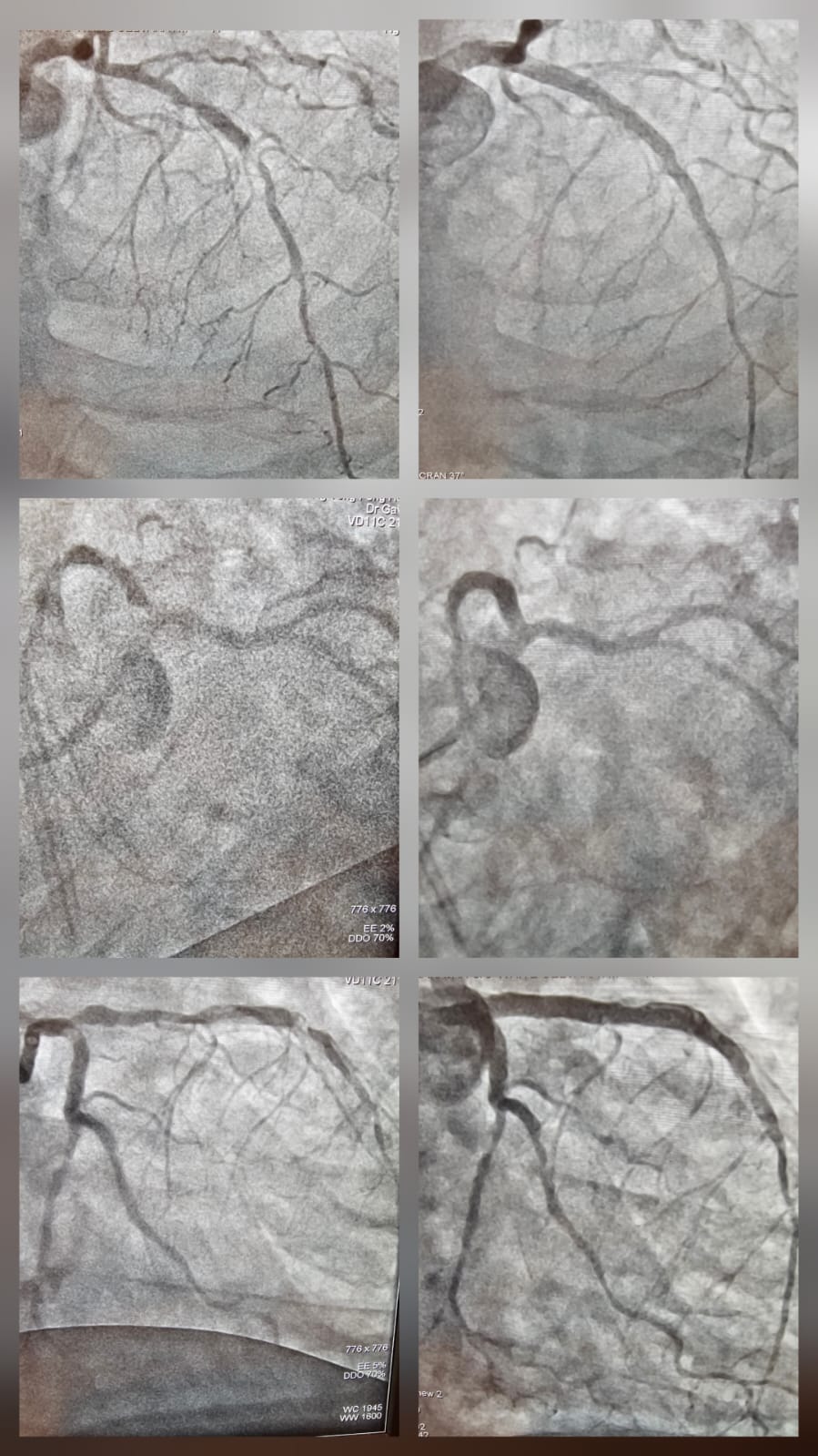 Multi-vessel coronary angiogram cases